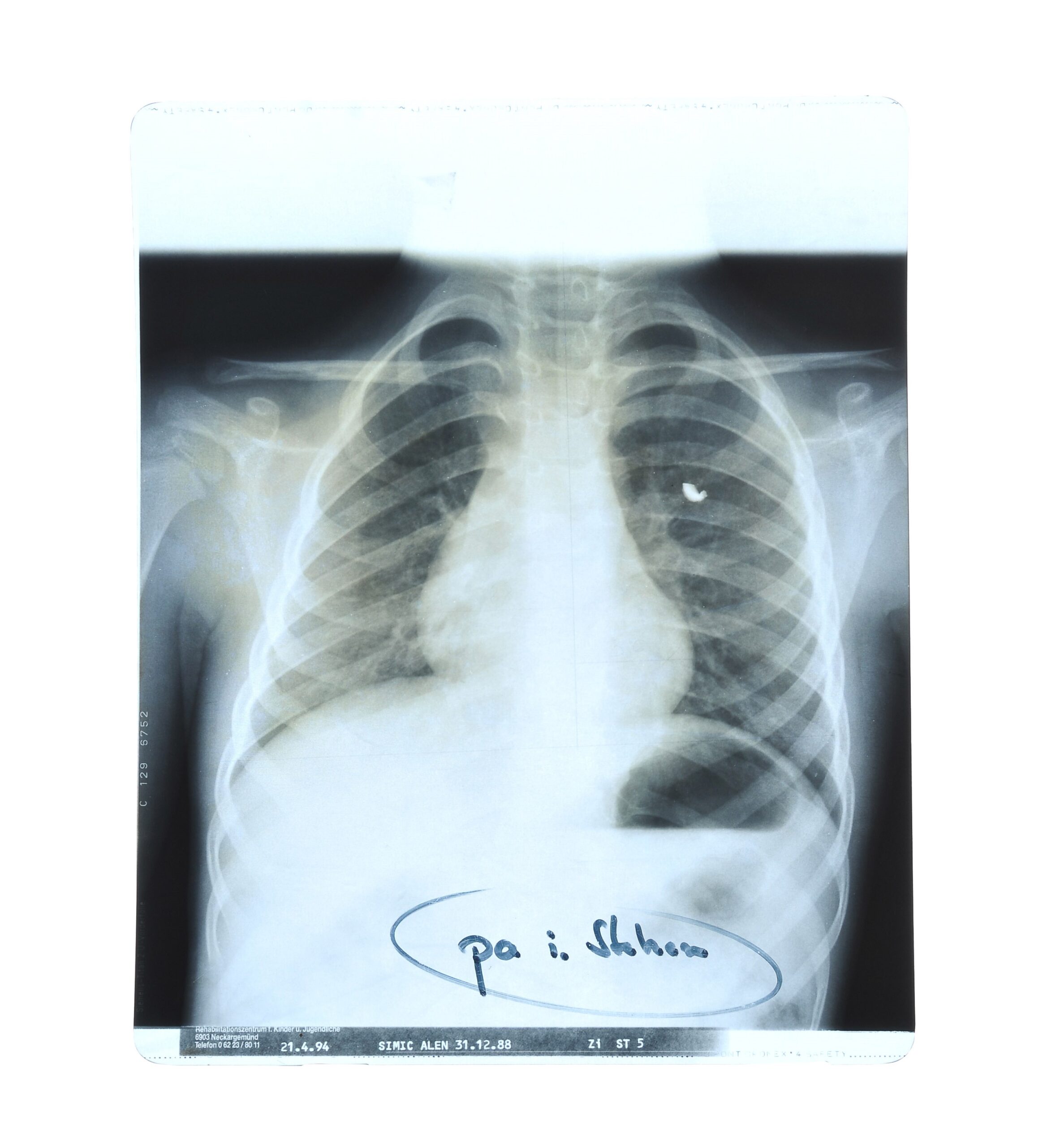X-ray image, with piece of shrapnel visible in ribcage